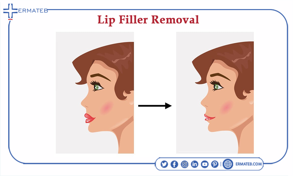 infographic of lip filler removal